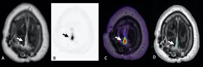 PET/MR Imaging of Somatostatin Receptor Expression and Tumor Vascularity in Meningioma: Implications for Pathophysiology and Tumor Outcomes